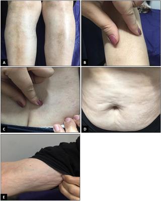 Pansclerotic Morphea Following COVID-19: A Case Report and Review of Literature on Rheumatologic and Non-rheumatologic Dermatologic Immune-Mediated Disorders Induced by SARS-CoV-2